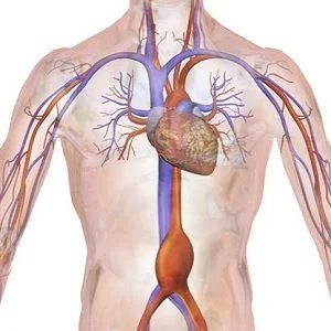 Drawing of an abdominal aortic aneurysm