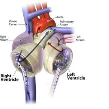 The Syncardia Total Artificial Heart 