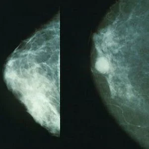 Normal (left) versus cancerous (right) mammography image