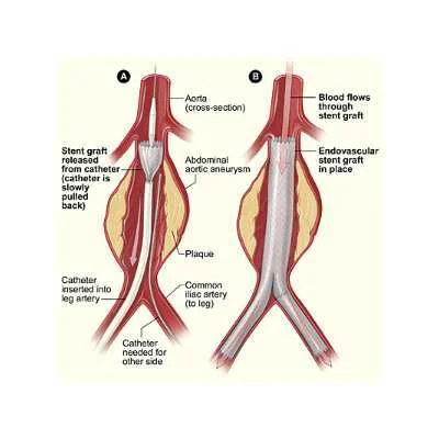 Endovascular repair