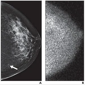 small MBI-occult invasive ductal carcinoma