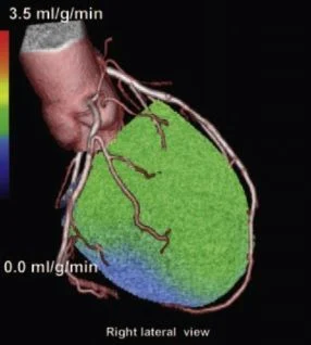 PET/CT image: stress myocardial perfusion is diminished in most areas (green and blue)