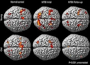 fMRI images of patients with MTBI