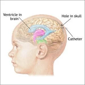 intracranial pressure monitoring (ICP)