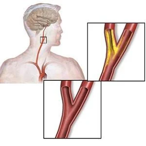 carotid artery disease