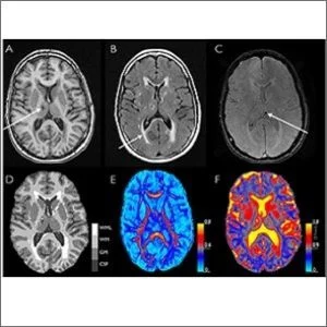 structural and microstructural brain changes on MRI