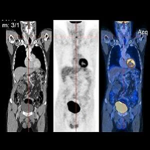 CT image (left), PET image (centre) and overlay of both (right)