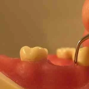 Periodontal disease 