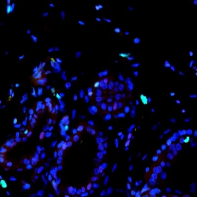 In healthy breast tissue, the percentage of cells expressing molecular marker Ki67 (green) and p27 (red) is low. Photo: Sung Jin Huh