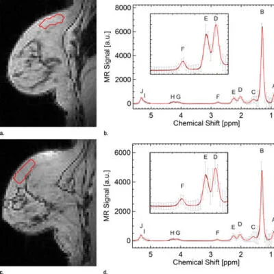 MRI Study Finds Increasing BMI Linked to Breast Cancer in Postmenopausal Women