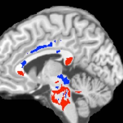 This image of a concussion patient&rsquo;s brain shows low FA areas (red) probably signifying injured white matter, plus high FA areas (blue) perhaps indicating more efficient white-matter connections compensating for concussion damage. A large amount of high F