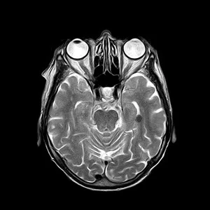 Neuroimaging Findings: Towards More Reliable Analysis 