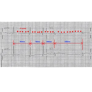 Social Inequality, Lifestyle and Heart Disease