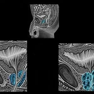 MRI Improves Prostate Cancer Detection, Avoids Unneeded Biopsy