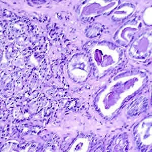 Normal and Malignant Prostates on MRI: Shape Differences 