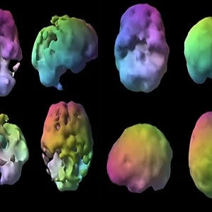 Representative brain SPECT scans in a patient with Alzheimer&#039;s dementia showing substantially reduced brain blood flow in the temporal and parietal lobes compared to a person with depression with mild decreased frontal lobe blood flow.