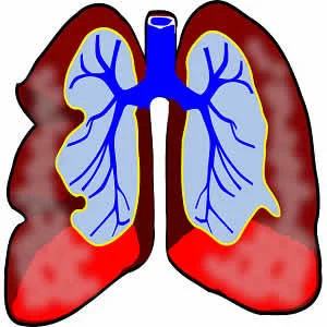 The Imaging of Small Pulmonary Nodules
