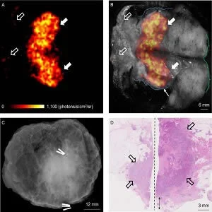 A This is a Cerenkov image; (B) Grey-scale photographic image overlaid with Cerenkov signal. An increased signal from the tumor is visible (white arrows); mean radiance is 871 &plusmn; 131 photons/s/cm2/sr, mean TBR is 3.22. Both surgeons measured the posterior 