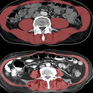 A new study of CTs shows that reduced size and density of core muscle (highlighted in red) as shown in the lower image is associated with frailty and reduced lifespan in hip-fracture patients.