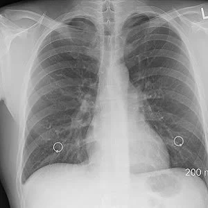 Rib Fracture Diagnosis in the Panscan Era