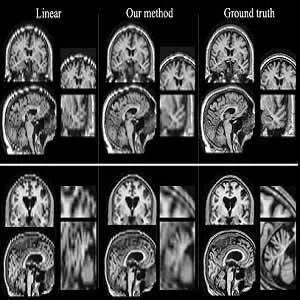 Researchers at MIT and other institutions have devised a way to boost the quality of low-resolution patient MRI scans so they can be used for large-scale studies. Images produced by their algorithm, shown in the center column, are much closer to high-reso