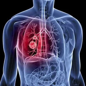 Lung cancer: differentiating metastatic from nonmetastatic lymph nodes 