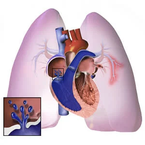 Echo indices for RVEF monitoring in pulmonary hypertension