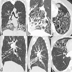 Typical features of primary ciliary dyskinesia on CT