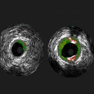 Shown are cross-sectional ultrasound images of coronary arteries from patients enrolled in the study. Plaque buildup (colored areas) in an artery from a patient that lacks sensitivity to red meat allergen (left) is much lower than plaque levels in an arte