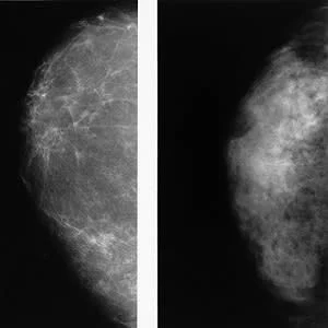 New study confirms higher cancer rate in women with dense breasts