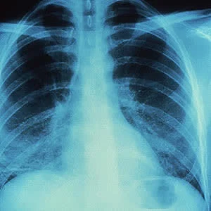 Machine learning &#039;red dot&#039; model for flagging abnormal radiographs