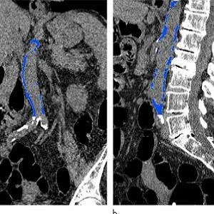 Images from CT colonography show segmented abdominal aortic calcification measured with semiautomated CT tool on (a) coronal and (b) sagittal images. Within region of interest over aorta selected by user, tool automatically segments and quantifies aortic 