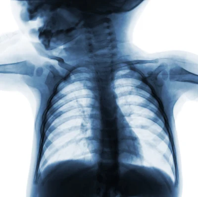 No decrease in x-rays for infants with bronchiolitis, despite guidelines 