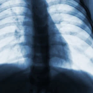 No decrease in x-rays for infants with bronchiolitis, despite guidelines 