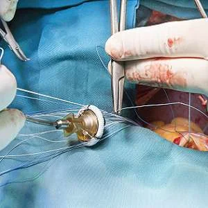 Heart valve surgery associated with cognitive decline