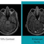 #RSNA18: AI may help reduce MRI gadolinium dose