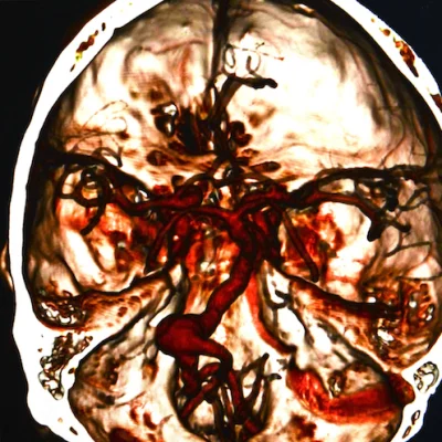 AI-powered system diagnoses and classifies intracranial haemorrhage