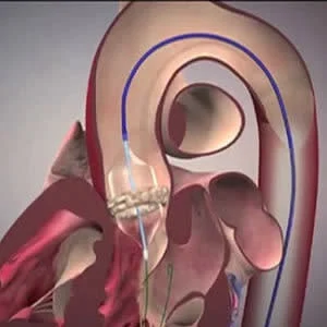 CT imaging in the context of TAVI/TAVR