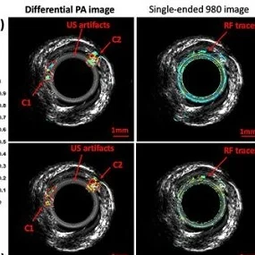 Imaging Modality Targets Cholesterol in Arterial Plaque