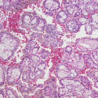 Radiogenomic Correlations in CT Imaging and MicroRNAs 