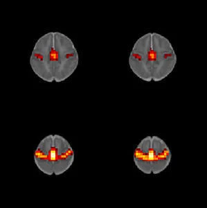 Prenatal Effect of Opioids