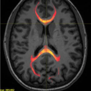 MRI Concussion