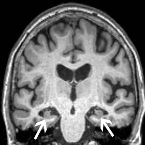 #RSNA20: Anxiety Associated with Faster Onset of Alzheimer&#039;s Disease