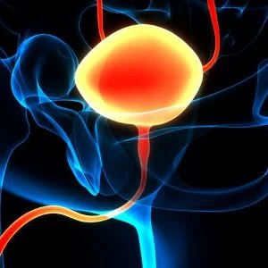 AI Improves Assessment of Bladder Cancer Treatment Response