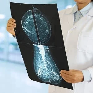 Changes in Breast Density Overtime Signals Breast Cancer Risk