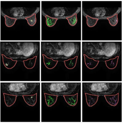 DCE-MRI Technique to Predict Breast Cancer Recurrence Risk