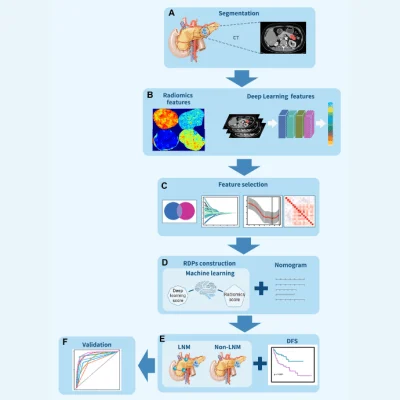 Novel Imaging Technique Offers Precise Prediction of Lymph Node Metastasis in Pancreatic Tumours