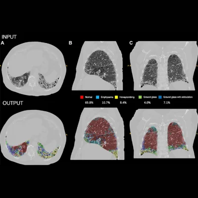 AI Improves Prognosis for Pulmonary Hypertension