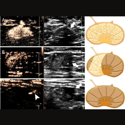 Nomogram Integrates CEUS &amp; Grayscale US to Predict Lymph Node Metastasis