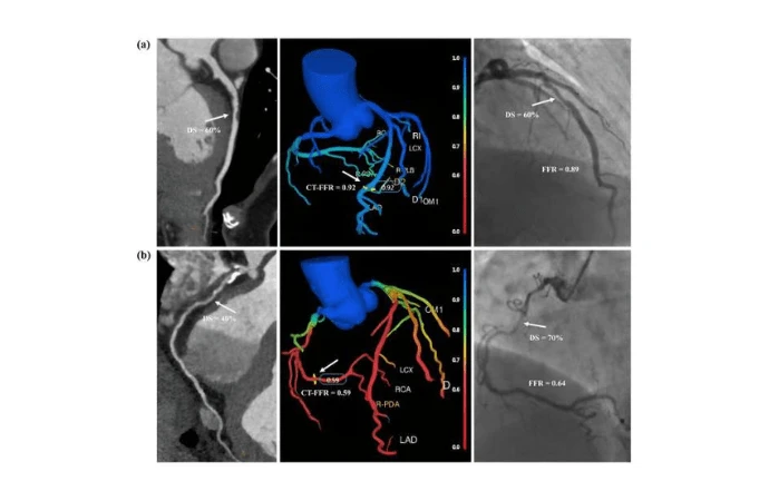 AI-Based Automated On-Site CT-FFR in Patients With CAD